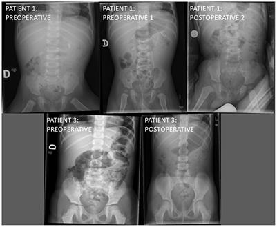 Micro-Ureteroscopy as a Treatment of Renal Pelvis Lithiasis in Young Children